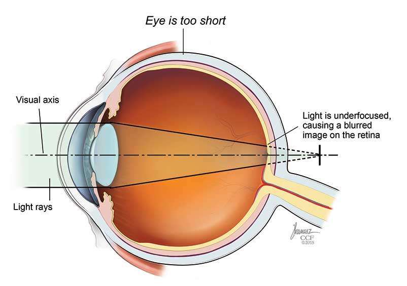 Nell'ipermetropia, l'occhio è corto da davanti a dietro e la cornea è più piatta del previsto.