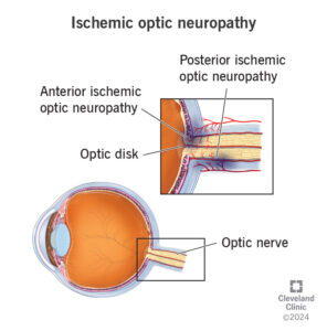 ischemic optic neuropathy