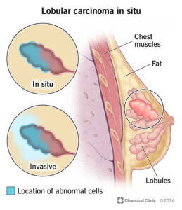 lobular carcinoma