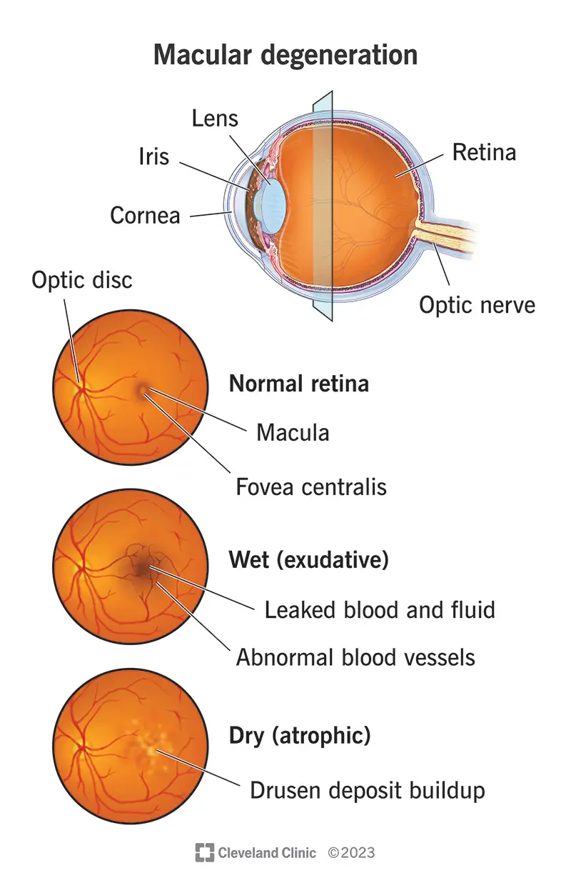 Sia la forma umida che quella secca della degenerazione maculare colpiscono la macula, una parte della retina dell'occhio.