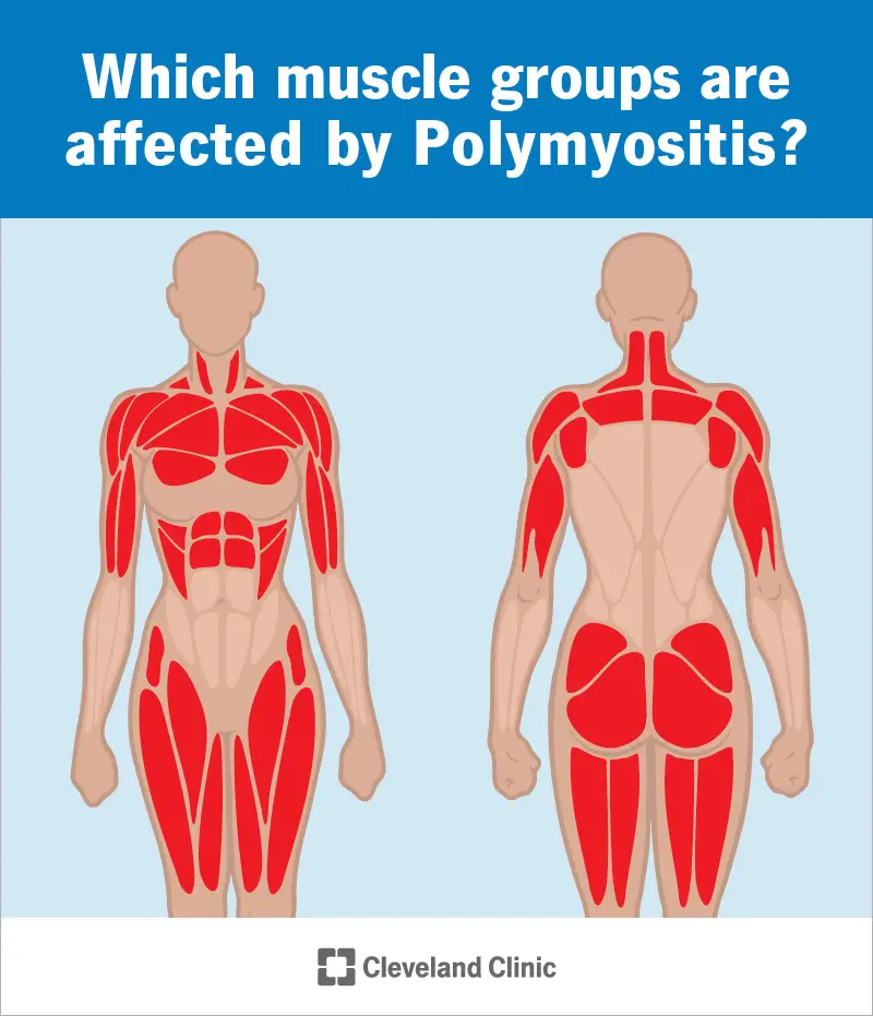 polymyositis infographic