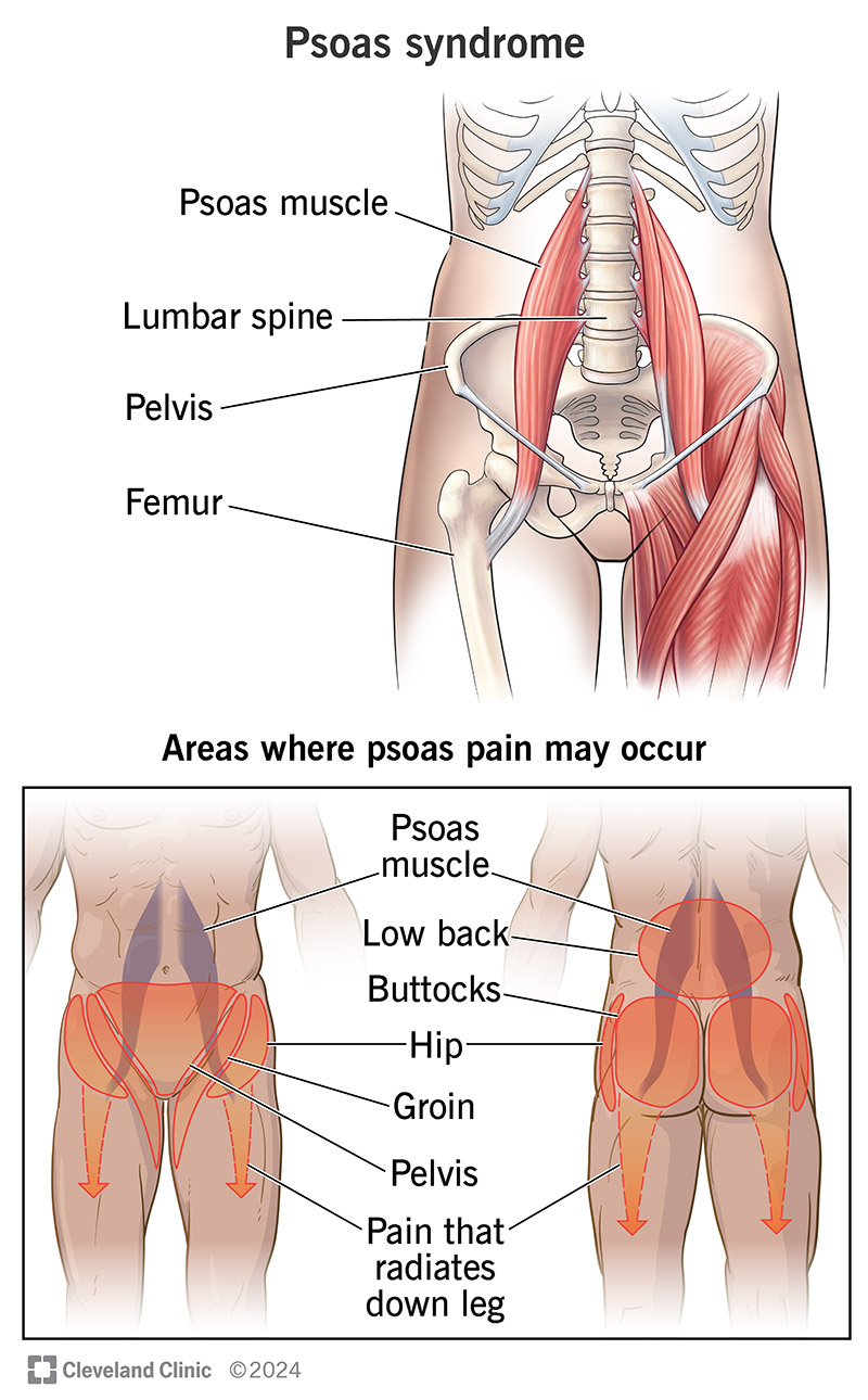 La sindrome dello psoas può causare dolore alla schiena, all'inguine, ai fianchi e ai glutei.