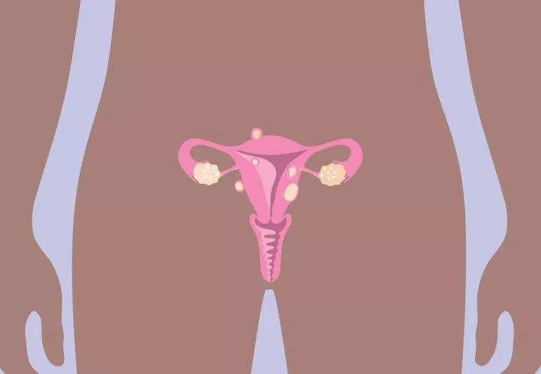 uterine Fibroid Tumors 1428226251 770x533 1 jpg