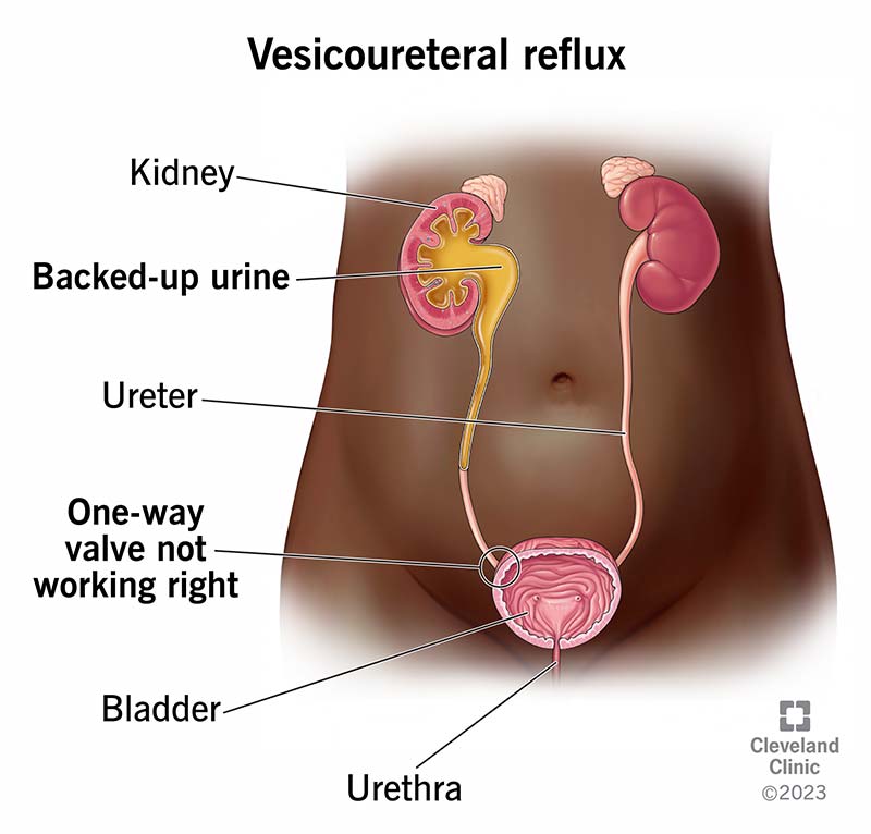 vesicoureteral