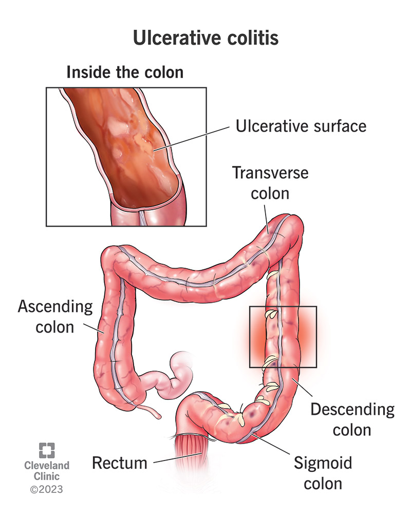 Infiammazione e ulcere nel colon discendente.