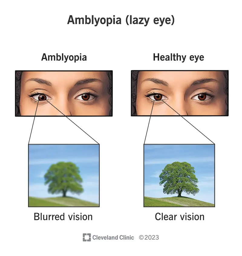 L'ambliopia provoca la visione offuscata di un occhio.