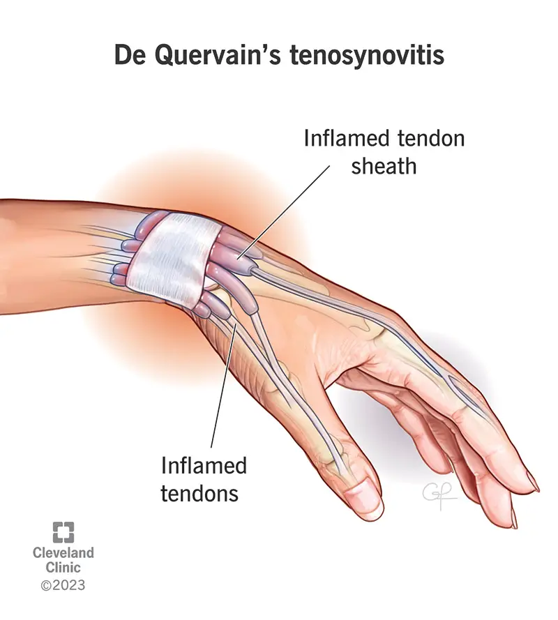 Un'illustrazione della tenosinovite di De Quervain.