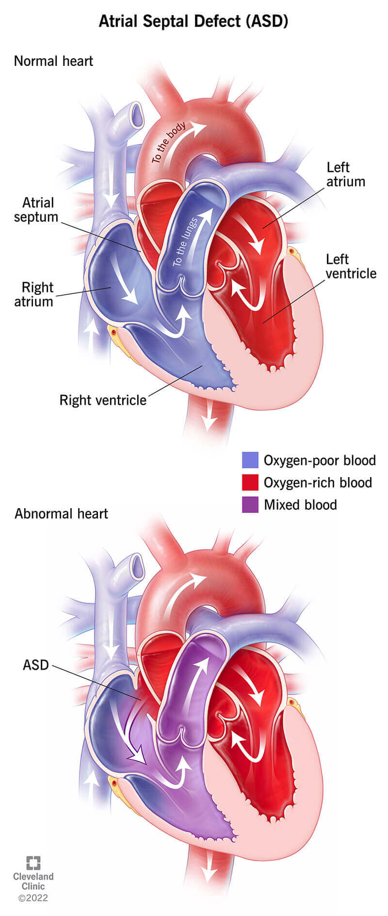 Illustrazione che confronta un cuore normale con un cuore affetto da difetto del setto interatriale.