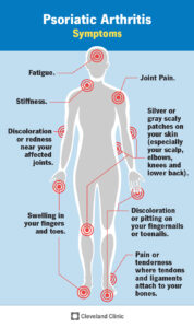 13286 psoriatic arthritis infographic