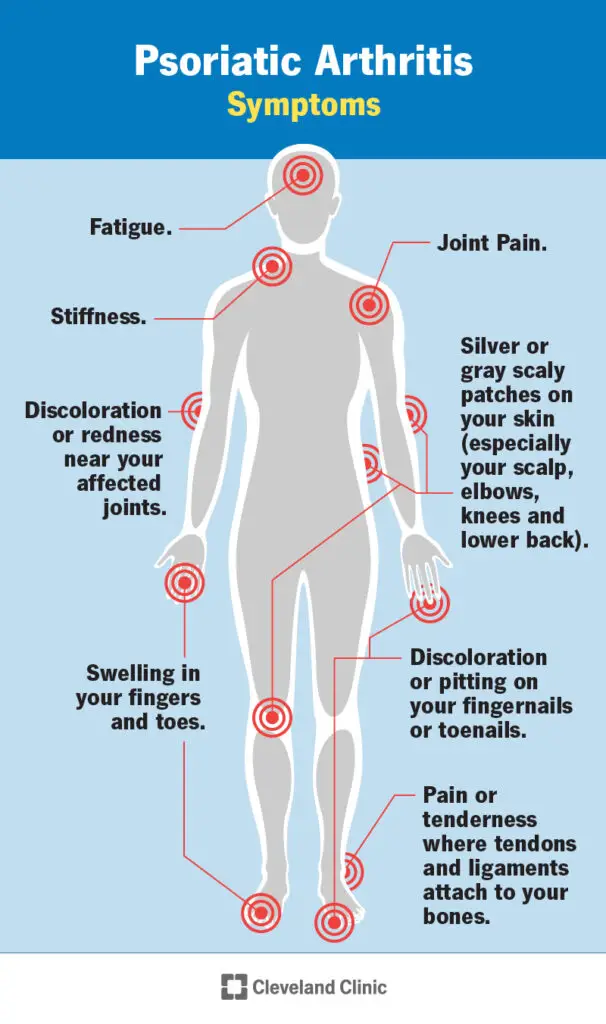 13286 psoriatic arthritis infographic