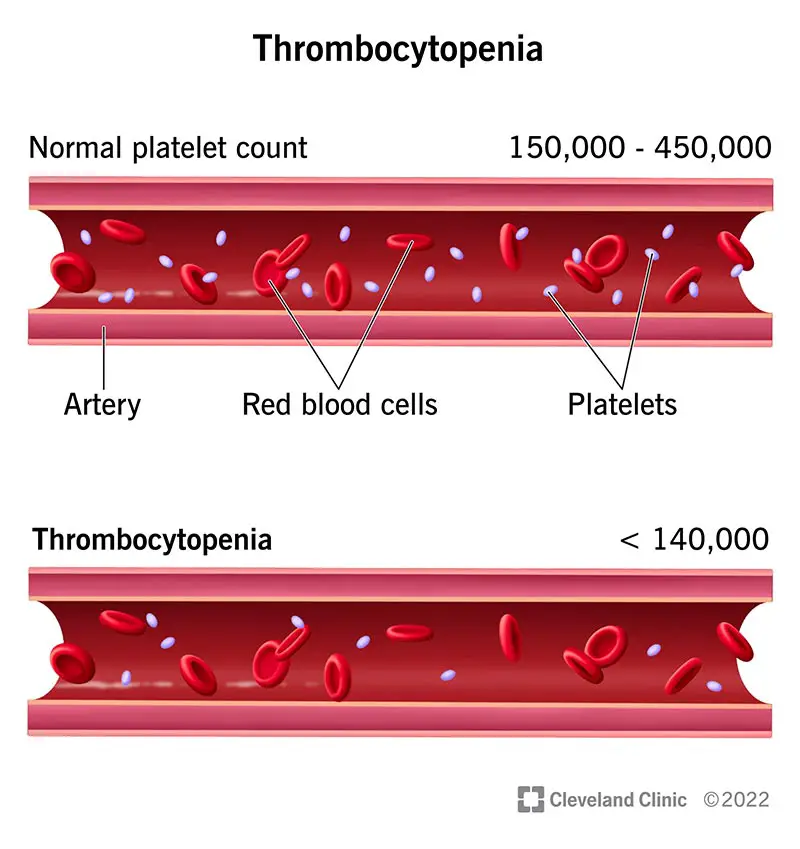 Un'arteria normale (in alto) e un'arteria con poche piastrine (in basso), come nella trombocitopenia.