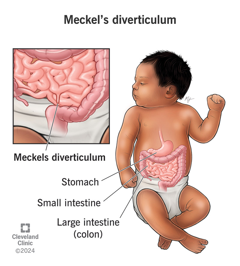 Vista interna dell'intestino di un neonato, in cui è visibile una piccola tasca nell'intestino tenue.