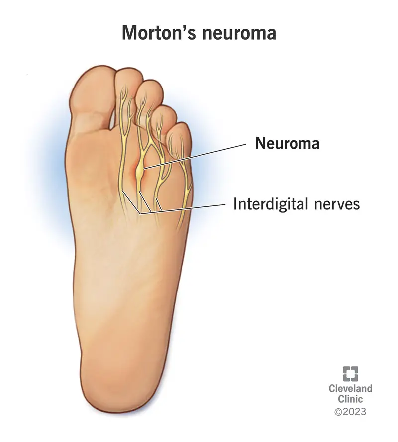 Un'illustrazione del neuroma di Morton su un nervo del piede di una persona.