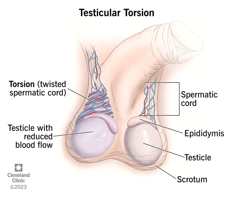 La torsione testicolare è una dolorosa torsione del funicolo spermatico nello scroto.