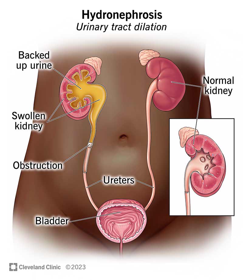 Anatomia del tratto urinario che mostra un rene ingrossato con urina che ristagna al suo interno.