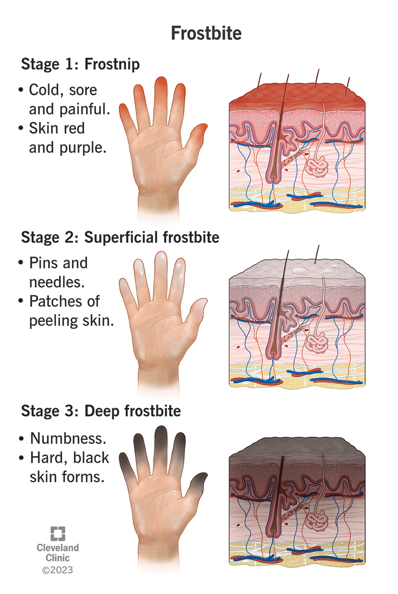 Illustrazioni realizzate a tre mani con la descrizione delle tre fasi del congelamento.