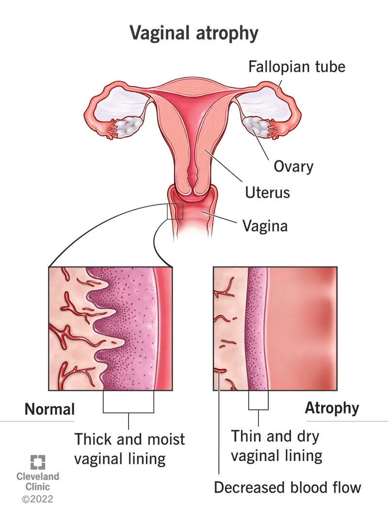 Confronto tra una mucosa vaginale normale, spessa e umida e una mucosa vaginale atrofizzata, che appare sottile e secca.