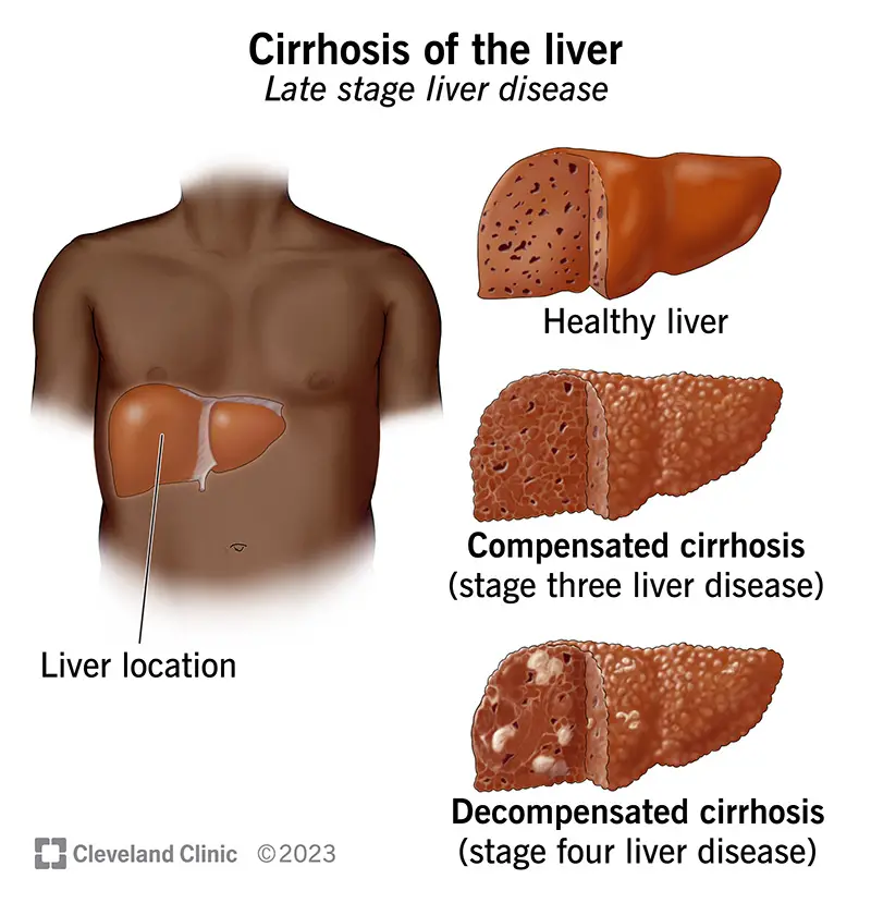 15572 cirrhosis