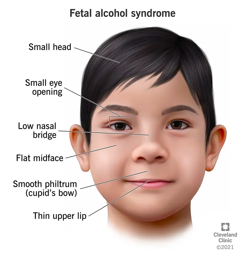 Il bambino nato con la sindrome feto-alcolica (FAS) presenta caratteristiche facciali distinte