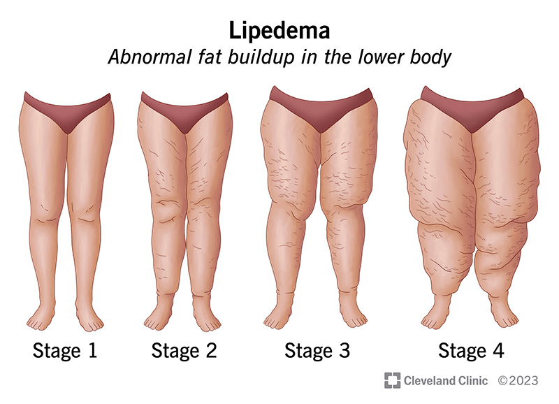 Il lipedema provoca un accumulo anomalo di grasso nella parte inferiore del corpo, che peggiora con il passare del tempo.