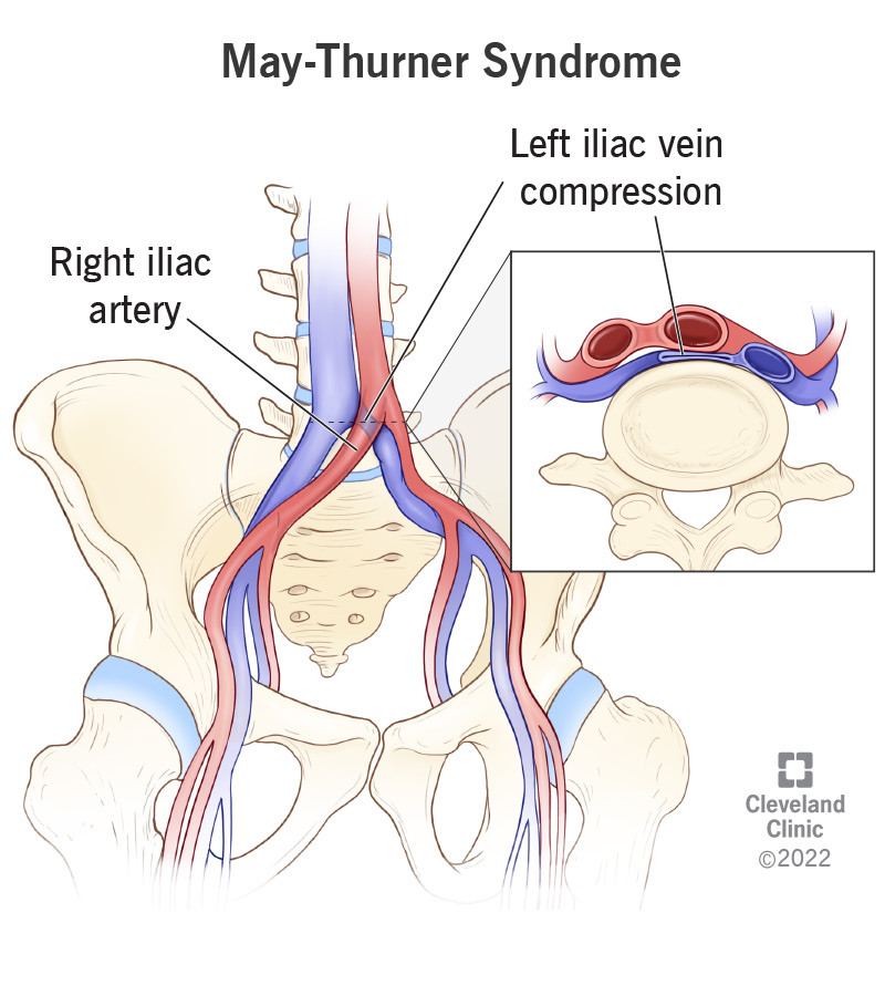 Arteria iliaca destra e vena iliaca sinistra in un disegno del bacino di una persona affetta dalla sindrome di May-Thurner.