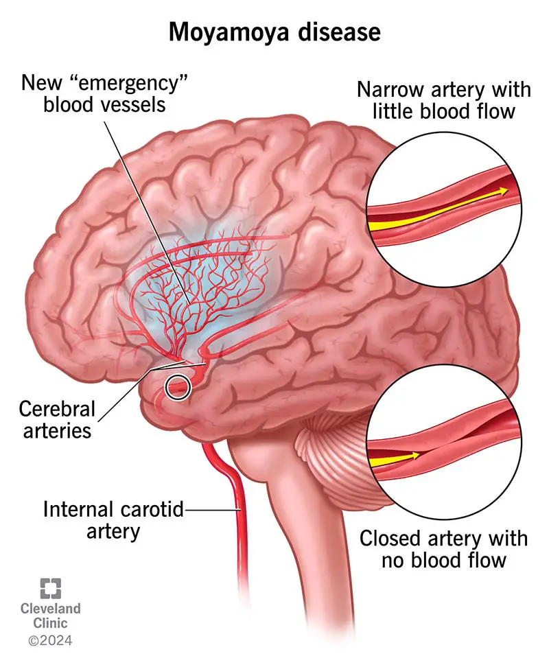 Nella malattia di Moyamoya, almeno una delle arterie carotidi (a volte entrambe) si restringe o si chiude.