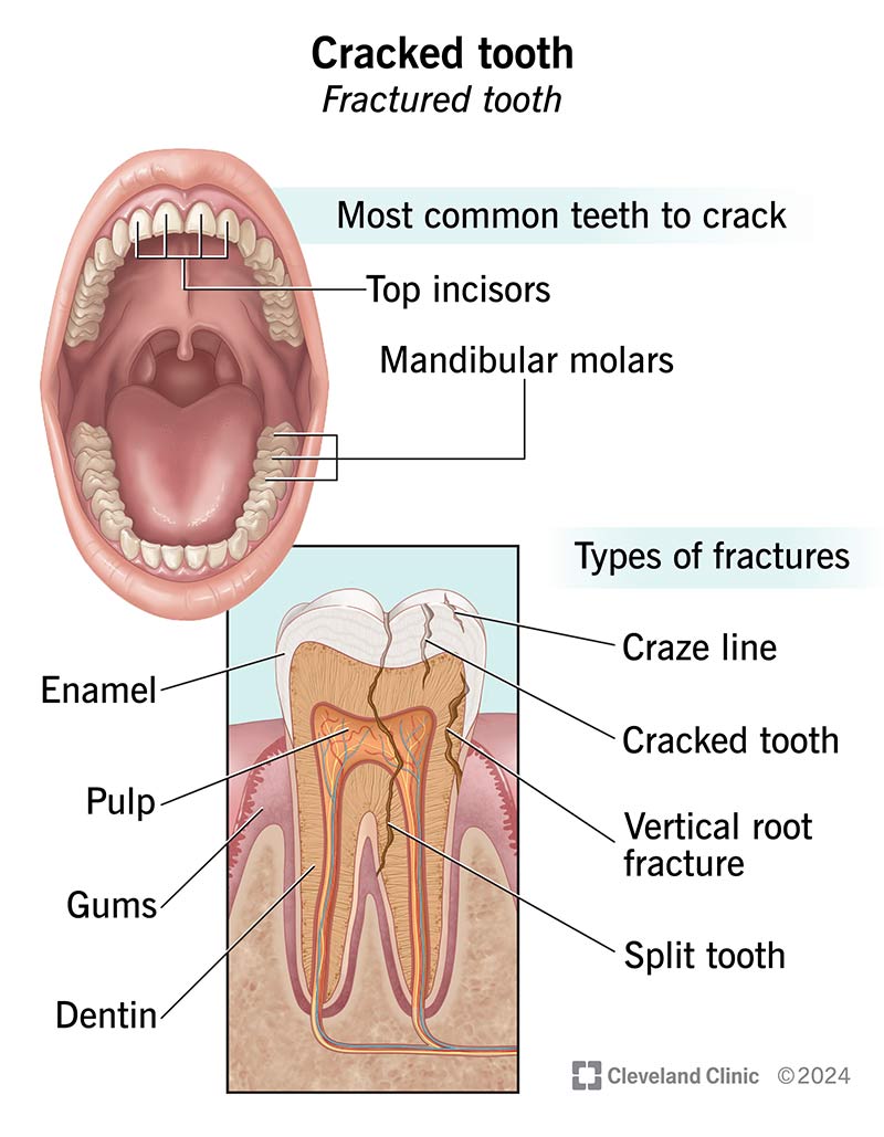 Dente Rotto (dente Fratturato) - SFOMC