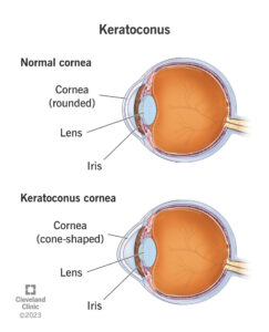 1725357616 keratoconus