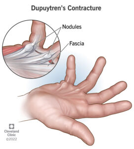 1725416718 16941 dupuytrens contracture