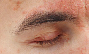 1725465617 25025 psoriasis on eyelids