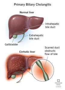 1725516327 17715 primary biliary cholangitis