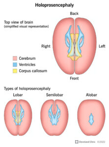 1725606619 22919 holoproscenephaly