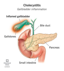 1725651918 15265 cholecystitis gallbladder inflammation