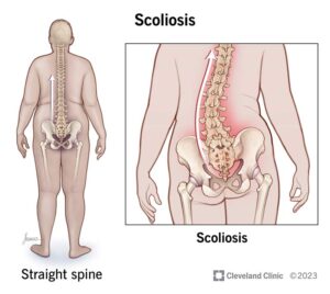 1725673816 15837 scoliosis