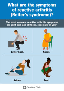 1725766817 reactive arthritis reiters syndrome