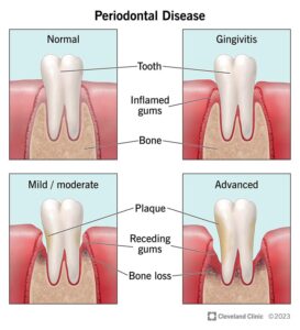 1725796215 21482 periodontal disease