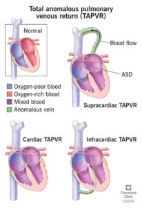 1725812715 23069 total anomalous pulmonary venous return illustration