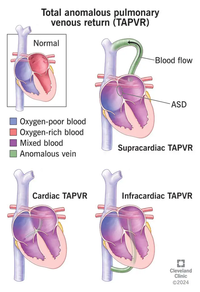 1725812715 23069 total anomalous pulmonary venous return illustration