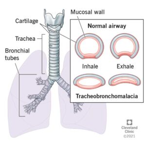 1725882019 22061 tracheobronchomalacia illustration