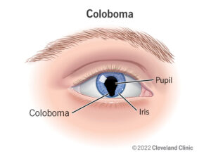 1726005316 22682 coloboma