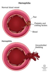 1726185017 14083 hemophilia