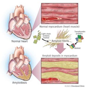 1726202418 22598 cardiac amyloidosis