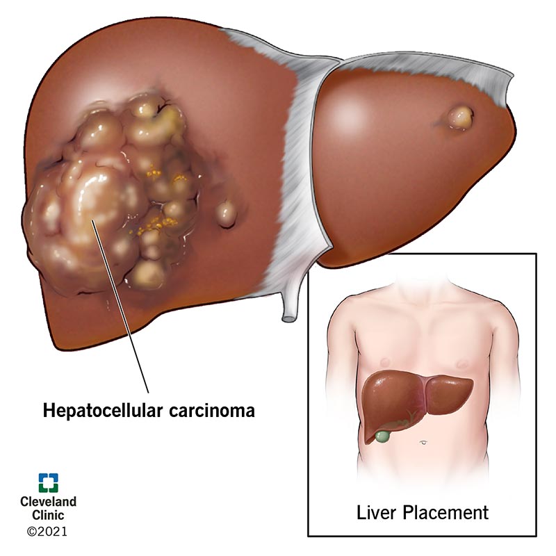 1726264516 21709 Hepatocellular Carcinoma Illustration