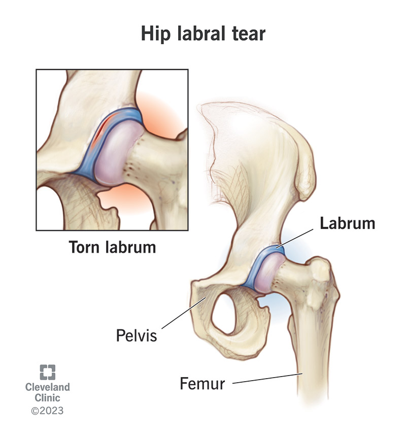 1726270815 hip labral tear