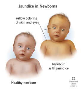 1726502416 22263 jaudince in newborns