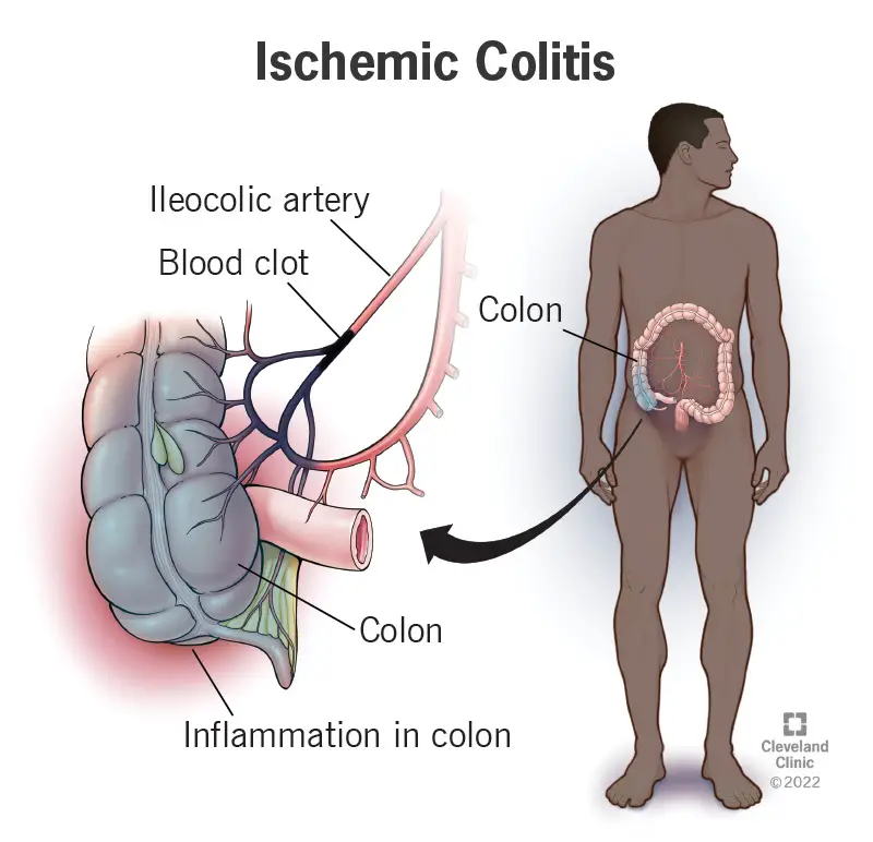 1726552516 24513 ischemic colitis