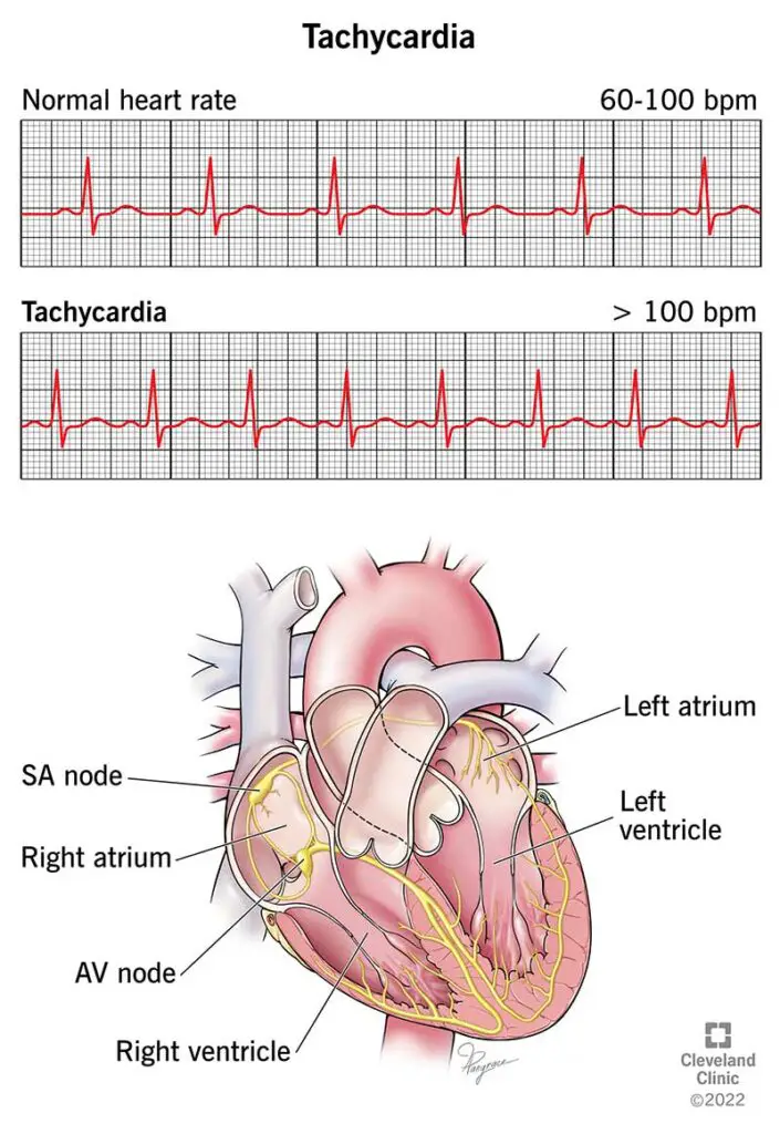 1726573213 22108 tachycardia illustration