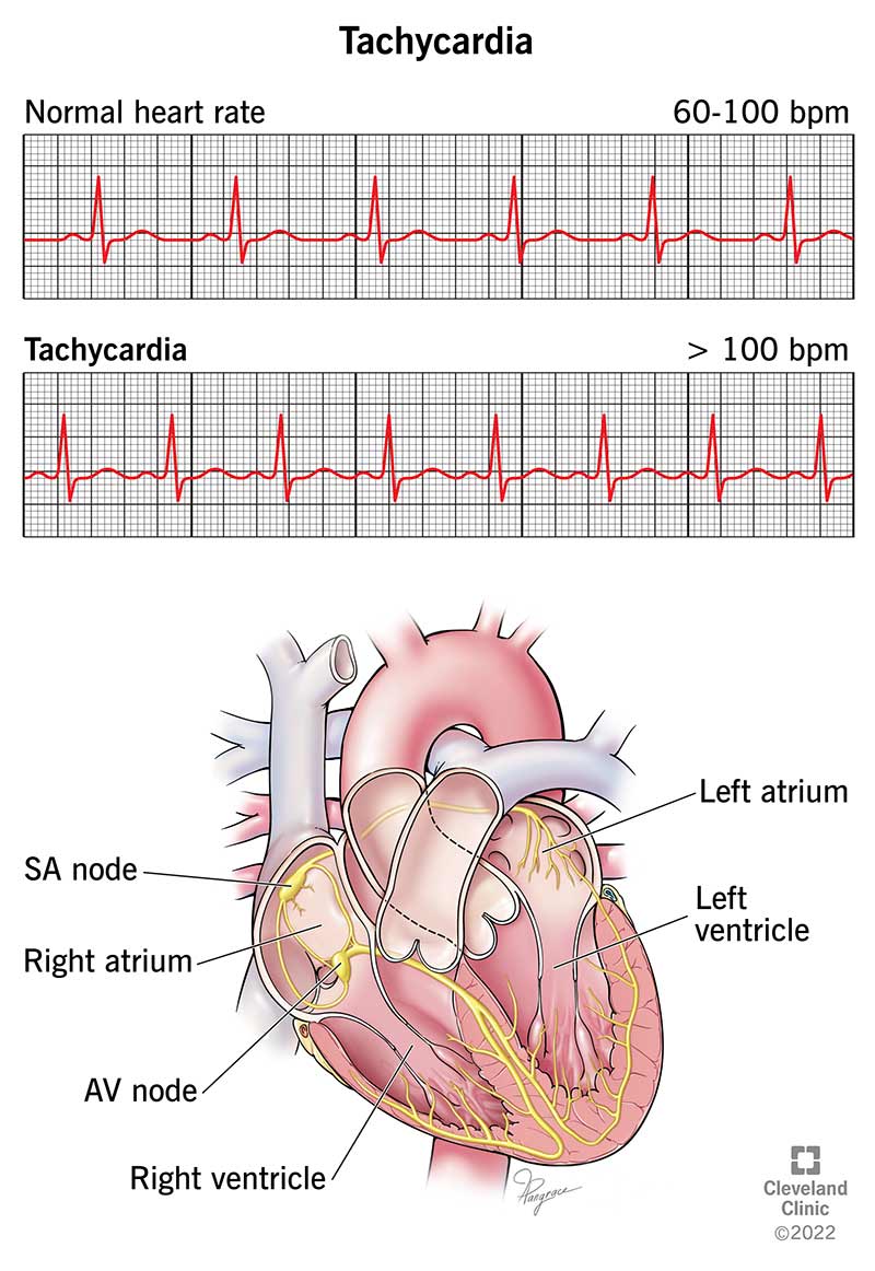 1726573213 22108 tachycardia illustration