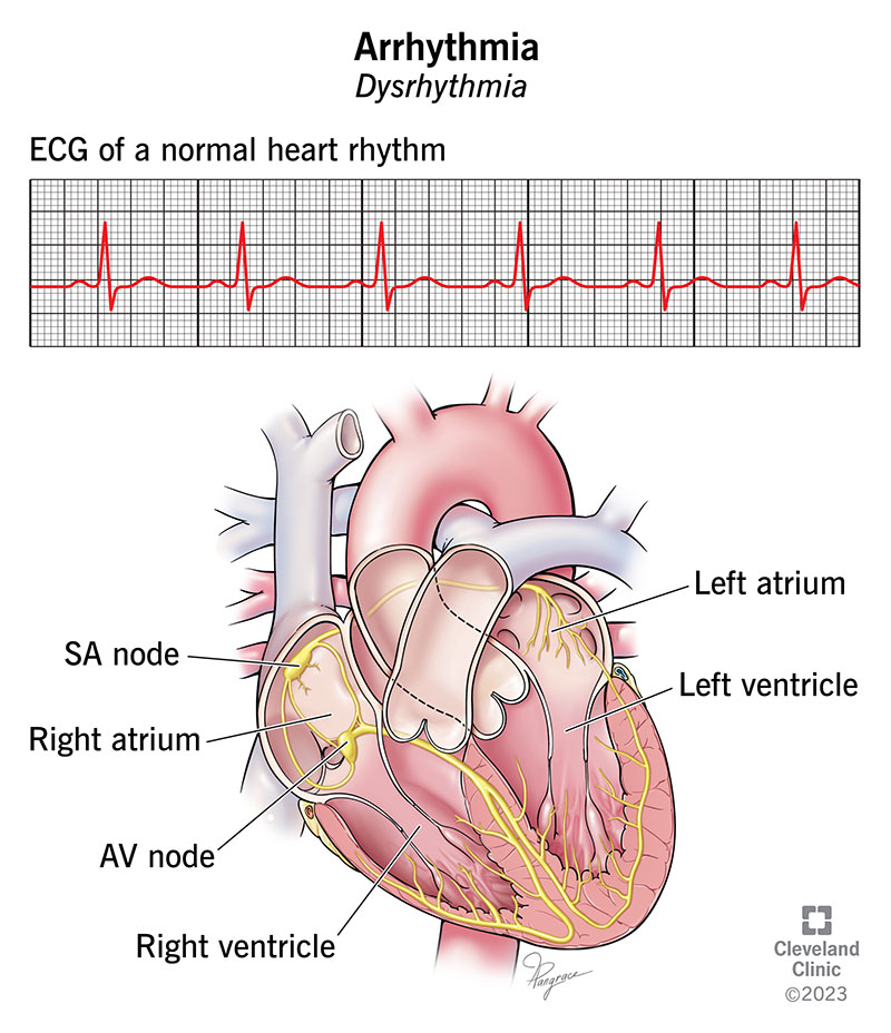 1726677017 16749 arrhythmia illustration