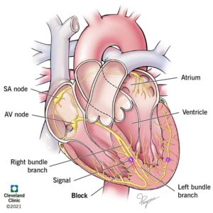 1726908614 21692 right bundle branch block illustration